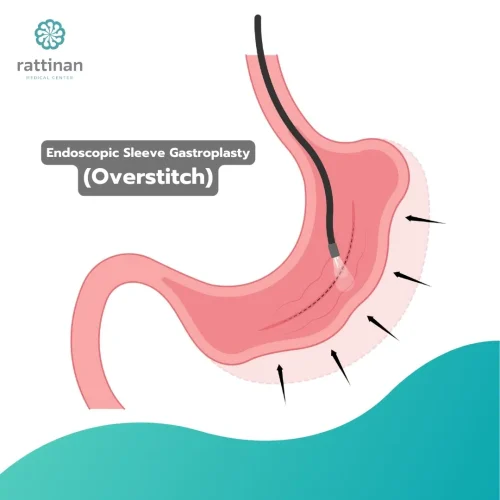 Endoscopic-Sleeve-Gastroplasty-Overstitch.jpg