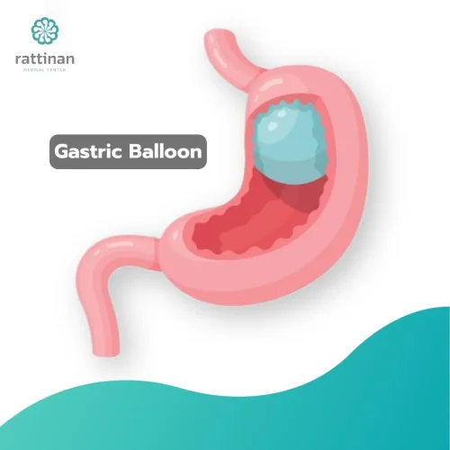 Gastric-Balloon.jpg