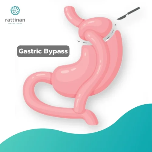 Gastric-Bypass.jpg