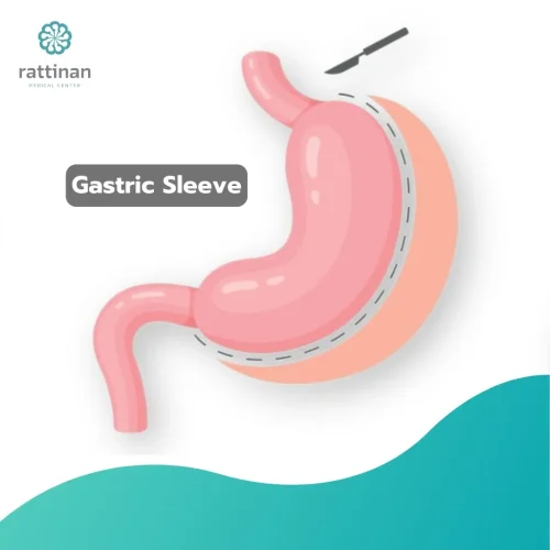Gastric-Sleeve.jpg